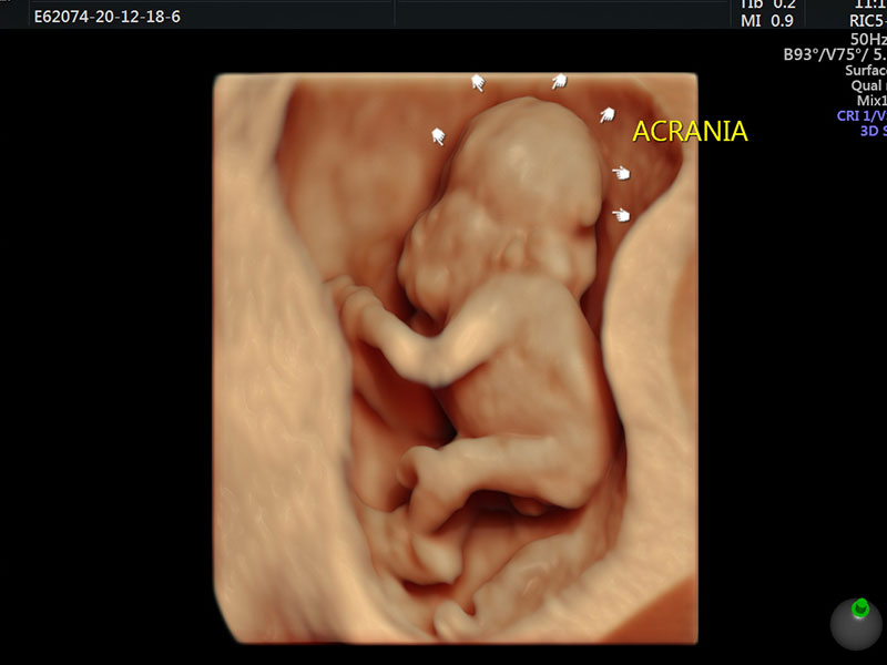 Anomaly Scan Test in Guntur