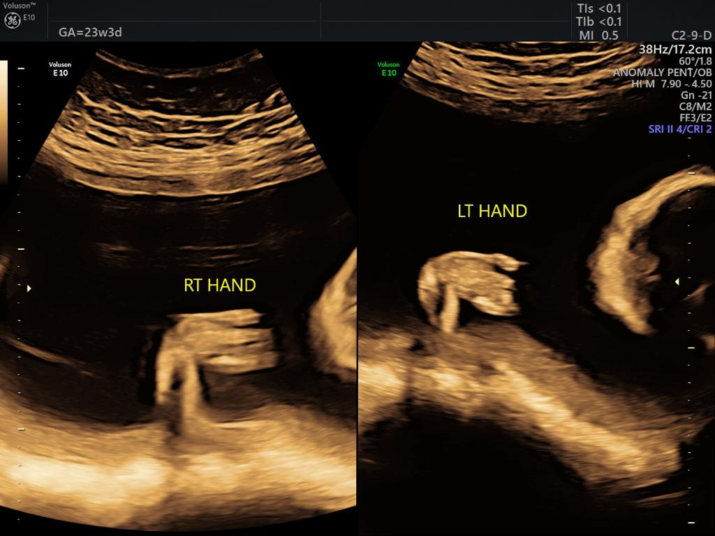 Anomaly Scan Test in Guntur