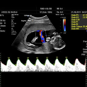 fetal doppler 